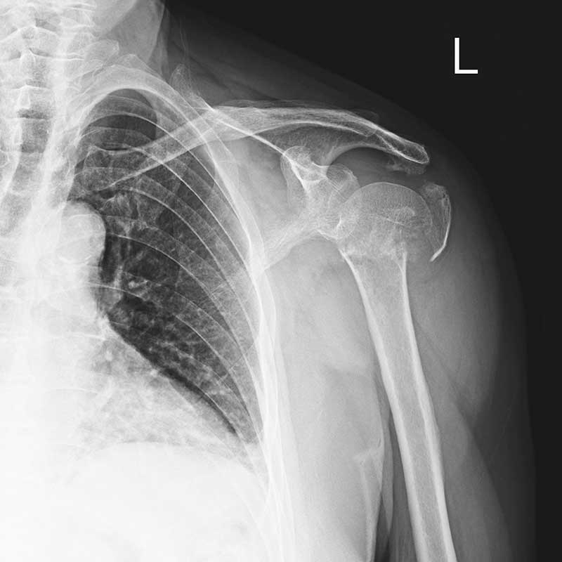 Indemnización Por Fractura De Clavícula